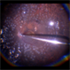 Completed Air-Fluid Exchange in Diabetic Vitrectomy Retina Surgery Completed Air-Fluid Exchange in Diabetic Vitrectomy Retina Surgery