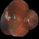 Retinitis Sclopetaria, 6 months later Retinitis Sclopetaria, 6 months later