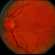 Macular Hole Evolving / Lamellar Hole Macular Hole Evolving / Lamellar Hole
