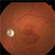 Syphilitic Uveitis