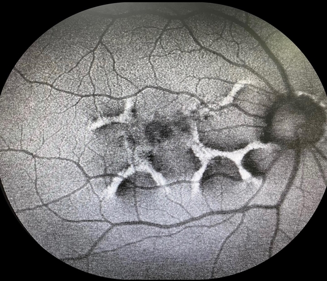 OD FAF Reticular Pattern Distrophy Retina Image Bank od-faf-reticular-pattern-distrophy-retina-image-bank