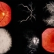 PE Cysts PE Cysts