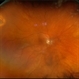 Macula Off Retinal Detachment Macula Off Retinal Detachment