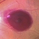 Retinal Artery Macro-aneurysms
