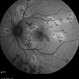 Active  multifocal choroiditis Active  multifocal choroiditis