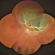 Retinal Detachment Retinal Detachment