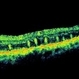 Retinal Folds Following Retinal Reattachment Surgery Retinal Folds Following Retinal Reattachment Surgery