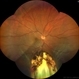 Retinal detachment, Coloboma Retinal detachment, Coloboma
