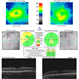 OCT Fundus