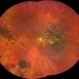 Healed Syphilitic Retinitis Healed Syphilitic Retinitis