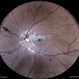 Venous Stasis Retinopathy