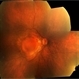 Myopic Traction Maculopathy Myopic Traction Maculopathy