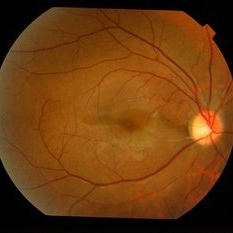 Cilioretinal artery occlusion in SLE - Retina Image Bank