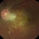Leptospirosis Neuroretinitis Leptospirosis Neuroretinitis