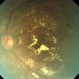 Clinically Significant Macular Edema Clinically Significant Macular Edema