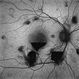 SUBHYALOID HEMORRHAGE