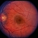 Solar Retinopathy / Familial Solar Retinopathy / Familial