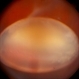 Lens Luxation Lens Luxation