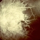 Primary Hyperoxaluria and Oxalosis