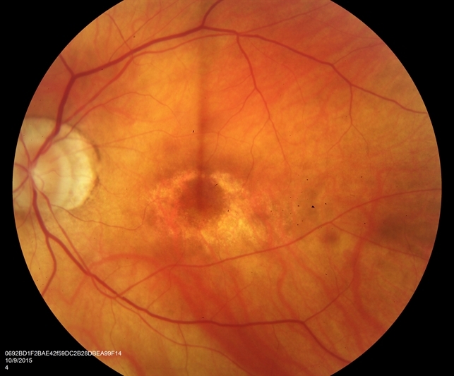 plaquenil-eye-exam-stiles-eye-group