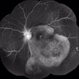Acute Syphilitic Posterior Placoid Chorioretinitis Acute Syphilitic Posterior Placoid Chorioretinitis