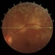 Choroidal Tuberculoma