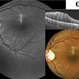 Combined Hamartoma of Retina and RPE Combined Hamartoma of Retina and RPE