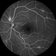 Susac's syndrome Susac's syndrome