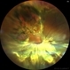 Recurrent Rhegmatogenous Retinal Detachment Recurrent Rhegmatogenous Retinal Detachment