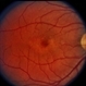 Pattern Dystrophy Pattern Dystrophy