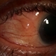 Conjunctival involvement uveal lymphoma Conjunctival involvement uveal lymphoma