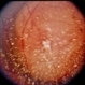 Choroidal Melanoma With Vitreous Seeding Choroidal Melanoma With Vitreous Seeding