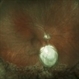 Retinal Detachment Repair in Patient With a Coloboma Retinal Detachment Repair in Patient With a Coloboma
