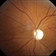 Glaucomatous Optic Atrophy Glaucomatous Optic Atrophy