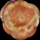 Choroidal Effusion Choroidal Effusion