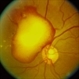 Subhyaloid Haemorrhage