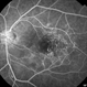 Macular Telangiectasia (FA Early Phase) Macular Telangiectasia (FA Early Phase)