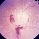 Primary Hyperoxaluria and Oxalosis