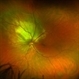 Choroidal Lesion Choroidal Lesion