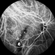 Tilted Disc Syndrome Complicated with RPE Atrophy and Polypoidal Choroidal Vasculopathy Tilted Disc Syndrome Complicated with RPE Atrophy and Polypoidal Choroidal Vasculopathy