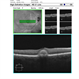Adult-onset foveomacular vitelliform dystrophy Adult-onset foveomacular vitelliform dystrophy