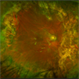 Submacular PFO Submacular PFO