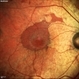 Choroideremia