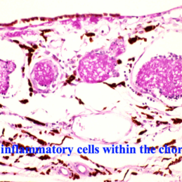 Pneumocystis Carinii Choroiditis - Retina Image Bank