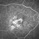Fibrovascular Retinal Pigment Epithelial Detachment - Fluorescein Angiography