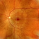 Congenital Hypertrophy of Retinal Pigment Epithelium (CHRPE) Congenital Hypertrophy of Retinal Pigment Epithelium (CHRPE)