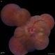 Optic Disc Edema With Macular Star