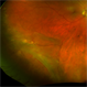 Retinal Dialysis Associated Detachment Retinal Dialysis Associated Detachment