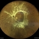 Tractional Retinal Detachment  in a Case of Proliferative Diabetic Retinopathy Tractional Retinal Detachment  in a Case of Proliferative Diabetic Retinopathy