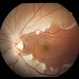 Vascular Loop Thrombosis Vascular Loop Thrombosis